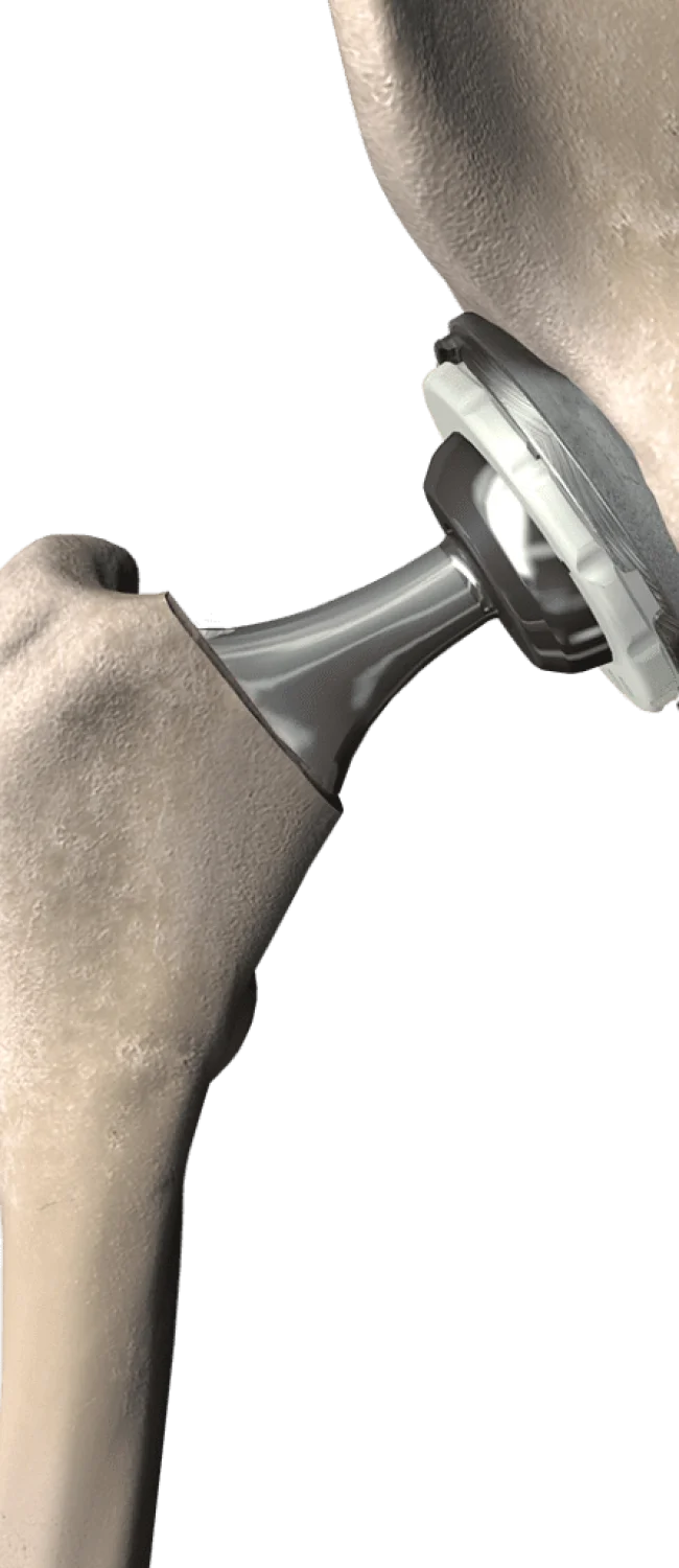 Hip Replacement Procedure