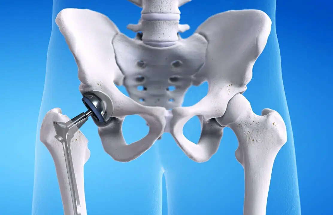Types of hip Replacement Surgeries
