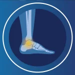 Ankle Replacement