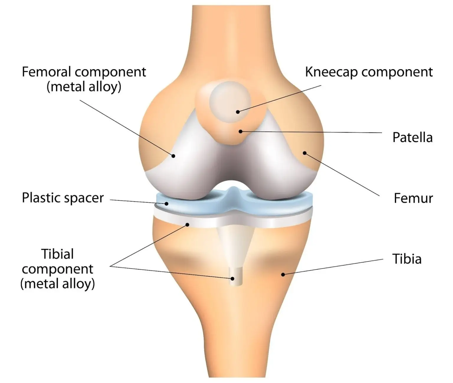 Joint-replacement