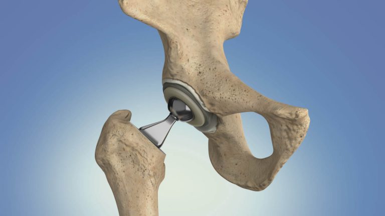 Hip Replacement Surgery
