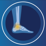 Ankle replacement surgery​